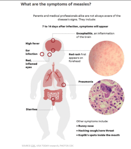 measles in calgary